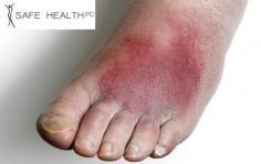 Cellulitis causes swelling, redness, pain and warmth, and can affect nearly all parts of the body. At Safe Health & Med Spa, we have an interdisciplinary team of physicians and nurses who specialize in treating infectious diseases like cellulitis and work together to develop treatment plans that prevent further complications and facilitate recovery. For more information, visit our website.