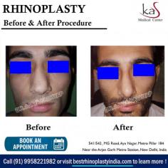 Looking for Best Nose Surgery in Delhi, India at Affordable Cost? KAS Medical Center has expert Rhinoplasty Surgeon in Gurgaon, Delhi NCR. For any kind of enquire about Nose Job surgery please complete our contact form or call +91-9958221983 or +91-9958221982.

Dr. Ajaya Kashyap Triple American Board certified Plastic Surgeon with over 30 years of experience in which 16 years in the U.S.A. & from the past 14 years he is in Delhi. You can learn more about on his website - www.bestrhinoplastyindia.com

We are offering ONLINE VIDEO CONSULTATIONS so that we can all stay connected during this time!

#nosesurgery #bestrhinoplastyindia #nosejobsurgeon #celebritynosesurgery #rhinoplastysurgeon #cosmeticsurgery #plasticsurgeon #drkashyap #Delhi #India
