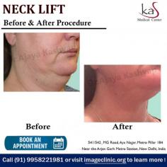 NeckLift can be done with or without a formal platysmoplasty where  the platysmal bands can also be  improved and the platysma muscle can be repaired in the midline to give a smooth and tight contour to the neck. For desired results book an appointment now with Dr. Ajaya Kashyap.

For further information regarding Neck Lift Surgery, please visit our website at www.imageclinic.org or write to us at info@imageclinic.org

Call / Whatsapp TODAY - 91 9818369662, 9958221982, 9958221983

#necklift #cosmeticsurgery #plasticsurgery #cosmeticsurgeon  #india
