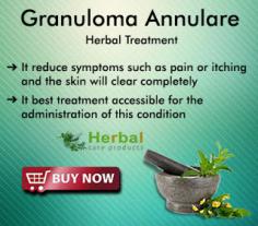 Granuloma Annulare Natural Treatment is one of the treatment models for skin problems. In some cases, a medical granuloma annulare treatment is essential to healing this skin problem. A person can use different herbal remedies Granuloma Annulare to obtain relief from this problem.
