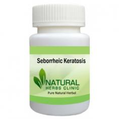 Herbal Treatment for Seborrheic Keratosis read the Symptoms and Causes. Natural Remedies for Seborrheic Keratosis and Supplement kill yeast and reduce itching.

