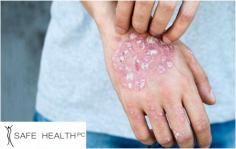 Psoriasis is a chronic skin condition that occurs when the skin produces new cells more rapidly than normal. Dr. Saif Fatteh, MD is one of the best dermatologists specializing in psoriasis who can design a treatment that works best for you. Learn about treatments & schedule your consultation today!