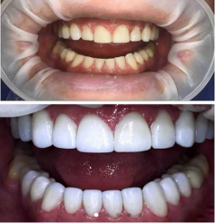 Colombia Care Dental is the #1 dental facility in Medellin for porcelain veneers in Colombia. Porcelain veneers Colombia are the most durable option for a smile makeover. Get your Free consultation from Colombia Care dental for affordable & best quality Porcelain Veneers in Medellin, Colombia. 