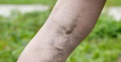 spider & varicose veins
At Fox Vein & Laser Experts, we offer a variety of vein treatment in Miami, options for both varicose vein and spider vein removal.
