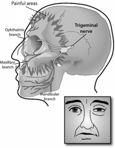 
Tension headaches occur when neck and scalp muscles become tense or contract, is continuous in nature, like a band around a head, pressure and squeezing in character and will last for few hours to few days.

The muscle contractions can be a response to stress, depression, head injury, or anxiety. They may occur at any age, but are most common in adults and older teens.