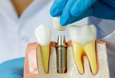 Best Dental Lab India - Manufacture and supply dental products - Dental prosthesis, Zirconia crown, dental implants, veneers, dmls, dentures, digital dentistry.. 