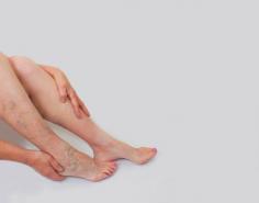 If you are interested to learn more about do varicose veins regrow after stripping, read our blog for more information.
