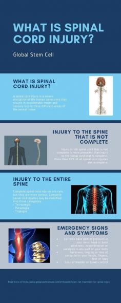 A spinal cord injury is a severe disruption of the human spinal cord that results in considerable motor and sensory loss in three different areas of the neural tissue. 