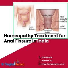 Anal fissure may occur when passing hard or large stools. These spasms can cause pain and slow down the healing process. Bowel movements can also prevent fissures from healing. Homeopathy treatment for anal fissure is recommended for effective treatment as it improves the digestive system. Book your appointment today: 7087462000 or WhatsApp at 9041111747, visit us: https://homeodoctor.co.in/best-homeopathic-medicine-and-treatment-for-anal-fissure-in-india/