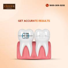 There are a variety of braces that align teeth based on individual needs. Get the desired results only with professional orthodontists at Clove Dental trusted by millions to straighten teeth without any complications. Book your appointment here with clove dental. 