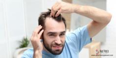 Male pattern baldness also called alopecia, is the most common type of hair loss in men. Read this blog post if you want to find out Is Finasteride (Propecia) an Effective Solution for Hair Loss?  