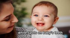 White Spots on Baby Teeth?

You are used to icing that your youthful child is happy and healthy. You feed them nutrient-rich refections, keep them active and stimulated, and track the mileposts they should be hitting as they grow. So if you've noticed a little white spot on your child's smile, you are presumably wondering what it's and how they got it. White spots on baby teeth can frequently be an early sign of tooth decay or indicate that your child is getting too important fluoride. Let's go over these two causes of white spots, how they do, and what to do about them!
