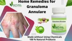 Herbal Supplements for Granuloma Annulare made with only herbal ingredients no any kinds of harm chemical used and provide excellent results in treating the skin problem. https://www.naturalherbsclinic.com/product/granuloma-annulare/