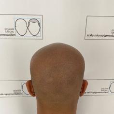 We are offering the best male pattern baldness treatment in Bangalore. Contact us for free consultation so that we can discuss your condition and suggest you the best possible treatment.