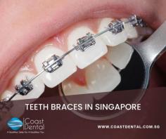 For those looking to straighten their teeth, the options for teeth braces Singapore are numerous and varied. Traditional metal braces are still a popular, affordable choice; however, many adults opt for less conspicuous treatments such as invisible ceramic braces or removable aligners. Depending on the severity of the misalignment Coast Dental offers teeth braces Singapore, Invisalign may be recommended as an orthodontic solution which uses clear, nearly invisible plastic trays designed to gradually shift your teeth into proper alignment. While more expensive than traditional metal braces, Teeth braces Singapore’s Invisalign may require fewer trips to the orthodontist since the removable trays can be changed at home and monitored remotely by your doctor. Of course, there are plenty of other options available so it is best to consult your dentist or orthodontist to determine which one is right for you.

My response: https://www.coastdental.com.sg/