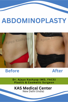 If you are planning to reduce tummy/abdomen fat do check us- www.besttummytuckindia.com
we have U.S. board certified Plastic & Cosmetic surgeon who is having 35+ years of experience in this field and serving in Delhi (India)