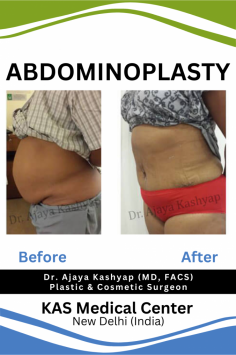 Thinking about getting an abdominoplasty but don’t know where to begin? Start by finding a board-certified plastic surgeon who can give you the results that are right for you. https://www.besttummytuckindia.com/#galleryWhy choose us:-✔ U.S. Board Certified Plastic & Cosmetic Surgeon✔ 35+ years of experience