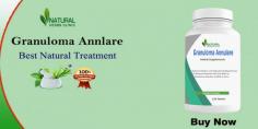 I strongly suggest giving Natural Herbs Clinic a try if you're looking for Natural Remedies for Granuloma Annulare as they can be very helpful for treatment.