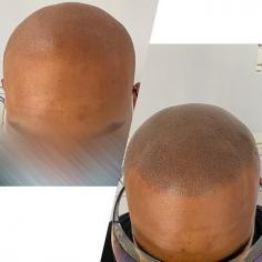 Are you looking for alopecia areata treatment in Bangalore? Emulate Follicles is offering the best treatment for alopecia for men. It is an amazing way to transform your personality and surprise your friends and loved ones.