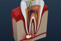 Here at Aloha Dental, we are proud to offer best root canal to our patients in Silverdale WA. We perform root canals on decayed teeth that can’t be fixed with fillings.
