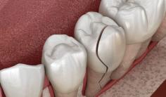 Here at Aloha Dental, we are proud to offer dental fillings to our patients in Silverdale WA. We provide broken fillings services with restore damaged teeth.
