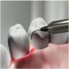 Dental Wellness is the leading clinic for Laser dental treatment in AECS layout. Laser dentistry is an advanced dental procedure with a minimally invasive method that is used to perform gum extraction, tooth removal, and other treatments.