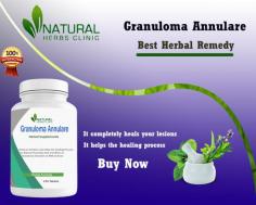 Here are some best Natural home cure for Generalized Granuloma Annulare Treatment completely without any side effects.
