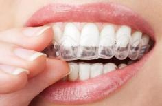 During your Invisalign treatment, you will receive a series of removable aligners that you will need to upgrade as your teeth move into position. Each aligner is individually manufactured the exact dimensions of your teeth, with each one changing slightly to facilitate the gradual movement, until they have straightened completely into the final position prescribed by your dentist.