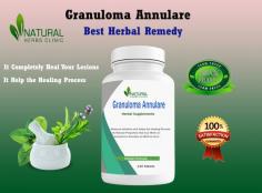 Granuloma Annulare Herbal Treatment commonly used as complementary approaches to help manage symptoms and support the healing process.
