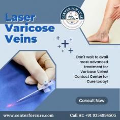 Our Center for Cure offers a variety of medical treatments that are designed to make your life easier. One of the treatments that we offer is varicose veins laser treatment in Delhi NCR. Varicose veins can be painful and cause a lot of discomforts, which is why it is important to have this treatment done. We offer this treatment in a number of different ways so that you can find the best way for you. Book your appointment today!