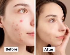 Buy Tretinoin Online: The Ultimate Guide

Buy Tretinoin online for any strength or skin concerns from acne, wrinkles, hyperpigmentation, and much more at a discounted price with quick shipping.

https://www.dallasnews.com/branded-content/2023/07/13/tretinoin-online-the-ultimate-guide/