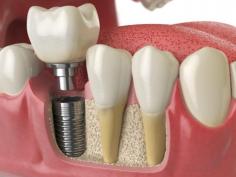 A dental implant is constructed with titanium. It is then integrated into the jawbone as a substitute for the root of the lost tooth. A prosthetic tooth or denture can then be fixed on this implant and help you function like normal once again.