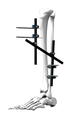 Discover valuable insights on selecting the ideal bone fracture fixator. Our guide offers essential tips and factors to consider, ensuring you make informed decisions when choosing the right device for a faster and effective recovery.

Read more:  <a href="https://www.madisonortho.com/blog/tips-to-choose-the-right-fixator-for-bone-fracture"</a>

