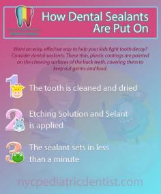How Tooth Sealants Prevent Cavities in Children and Teens
Dental sealants are a great way to protect your growing child’s teeth from cavities. Sealants can prevent decay by as much as 80 percent, according to the American Dental Association (ADA.) A relatively recent advance in children’s dentistry, dental sealants for kids teeth help avoid much more costly dental restorations. It’s a win-win!

What Are Sealants for Kids Teeth?
Dental sealants are protective plastic coatings applied to the chewing surfaces of primary (baby) and permanent (adult) molars to prevent tooth crevices from trapping food particles and bacteria. Sealants are recommended by the ADA and the American Academy of Pediatric Dentistry (AAPD).

How Dental Sealants Prevent Decay?
Sealants act as a barrier to food, plaque and acid to protect the decay-prone areas of the teeth. The back teeth are the ones that are most likely to show signs of decay, so it is important to take this extra step to help protect them.

Sealants are applied when molars erupt beyond the gums, generally between five and 10 years of age. They and are not typically visible when a child laughs, talks, or smiles. While sealants can last for many years, they need to be maintained and evaluated for wear, and occasionally require touch-ups.

How Tooth Sealants Are Applied?
First, the tooth is cleaned and dried, and then coated with a gel formula. When the gel dries, the tooth is then brushed with dental sealant resin, which is also allowed to dry. Sealants can be white, clear, or slightly tinted to match the color of the tooth, and are not typically noticed when you laugh, talk, or smile.

No pain, no drilling A good deal of skill is required of the pediatric dentist Dr. Babich to apply the tooth sealant for child properly. The application of dental sealants is a pain-free process. There is no drilling or removal of any part of the tooth structure during the process. Depending upon the specific type of material used, the dental sealant may be hardened by exposure to light.

Dental sealants, combined with good oral hygiene habits, healthy eating, and regular professional dental cleanings, are a great way to help keep your child’s teeth healthy and strong throughout their lives.

Do you have any questions about the dental sealants for kids and teens teeth we offer in NYC? Would you like to schedule an appointment with the top New York City pediatric dentist Dr. Sara Babich? Please call our office at 212-988-4070 or visit our pediatric dentistry center in Manhattan on Upper East Side.

Read more: https://www.nycpediatricdentist.com/sealants/

Pediatric Dentistry: Dr. Sara B. Babich, DDS
116 E 84th St,
New York, NY 10028
(212) 988-4070
Web Address https://www.nycpediatricdentist.com/
https://nycpediatricdentist.business.site/
E-mail info@nycpediatricdentist.com

Our location on the map: https://g.page/dr-sara-babich-pediatric-dds-nyc
https://plus.codes/87G8Q2HV+83 New York

Nearby Locations:
Carnegie Hill | Yorkville | Lenox Hill | Upper East Side | Midtown Manhattan
10029 | 10028 | 10021| 10044, 10065, 10075, 10128 | 10022

Working Hours :
Monday: 9AM-6PM
Tuesday: 9AM-6PM
Wednesday: 9AM-6PM
Thursday: 9AM-6PM
Friday: 9AM-4PM
Saturday: Closed
Sunday: Closed

Payment: cash, check, credit cards.