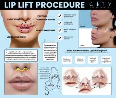 A bullhorn lip lift is a special type of upper lip lift surgery, which is aimed to reveal more of the pink upper lip. This cosmetic procedure is also known as subnasal lip lift. Dr. Gary Linkov, as an experienced facial plastic surgeon, offers bullhorn lift lip surgery at City Facial Plastics, located in Manhattan, NY.

Dr. Linkov uses new lip lift techniques based on sex, age, occupation, and aesthetic perception and considers an individual’s geographic, ethnic, cultural traditions, and demographic background to achieve fuller, “ideal” lip characteristics. Specializing in Lip Lift surgery in New York City, he has been named one of the top 5 lip lift surgeons in the United States.

Read more: https://cityfacialplastics.com/bullhorn-lip-lift/

City Facial Plastics
1AB, 150 E 56th St,
New York, NY 10022
(212) 439-5177
Web Address https://cityfacialplastics.com
https://cityfacialplastics.business.site/
E-mail info@cityfp.com

Our location on the map: https://goo.gl/maps/2ijBCh1XDqJz9GM1A
https://plus.codes/87G8Q25J+VC New York

Nearby Locations:
Upper East Side | Lenox Hill | Hell's Kitchen | Midtown Manhattan | Murray Hill
10021, 10028, 10044, 10065, 10075, 10128 | 10019 | 10022, 10017 | 10016

Working Hours :
Monday-Friday: 8AM - 5PM

Payment: cash, check, credit cards.