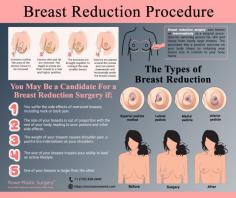 While some women dream of larger breasts, others dread the discomfort caused by the weight of their large bosom. If your breasts are out-sized for your body or if they’re causing shoulder, back or neck pain, there is an answer: mammaplasty or breast reduction surgery. This safe medical procedure, when performed by the expert breast surgeons at Rowe Plastic Surgery in New York, reduces your enlarged breasts to a more comfortable size that relieves your pain and discomfort. Every breast reduction includes a breast lift to maintain the appearance of your breasts.

New York City breast reduction doctors are board-certified plastic surgeons, among the top reduction mammoplasty specialists focusing on minimally invasive breast reduction surgery. As leading experts in macromastia (breast hypertrophy), they are among the best breast reduction doctors in New York City, concentrating on excess breast weight, breast malposition as well as cosmetic appearance (asymmetry, minimal scarring), and rapid recovery.

What Is Breast Reduction Surgery?
Breast reduction surgery, also known as mammoplasty, is a surgical procedure for removing excess fat, skin and tissue from overly large breasts. The procedure has a positive outcome on your body shape by reducing your breast size in relation to your body frame. For most women, the reduction procedure reduces your breast size one or two cup sizes. During the procedure, your surgeon takes special care to maintain your breasts’ functionality and sensitivity.

If you’re troubled by the large size or weight of your breasts, visit the team at Rowe Plastic Surgery for this life-changing breast reduction surgery. These board-certified cosmetic surgeons offer high-quality breast surgery procedures at their state-of-the-art facilities in Manhattan, Long Island.

Read more: https://normanrowemd.com/procedures/breast/breast-reduction/

Rowe Plastic Surgery
267 Broad St,
Red Bank, NJ 07701
Tel.: (732) 838-6640
Fax.: (732) 852-2771

820 Park Ave # 1b,
New York, NY 10021
Tel.: (212) 300-9873
Fax.:(212) 628-7302
Web Address https://normanrowemd.com
https://normanrowemd.business.site/
https://normanrowemdny.business.site/
E-mail drrowe@normanrowemd.com 

Our locations on the map: 
NJ https://g.page/roweplasticsurgerynj
NY https://goo.gl/maps/rNaSMRmxJsXqVdpf7

Nearby Locations:
Red Bank:
Red Bank | Shrewsbury | Shrewsbury Township | Little Silver | Fair Haven
07701, 07704 | 07702, 07703 | 07724 | 07739, 07757

New York:
Upper East Side | Carnegie Hill | Yorkville | Lenox Hill
10021, 10028, 10065, 10075, 10128 | 10029 | 13495

Working Hours:
Available 24 Hours for Emergency Care. 
For Appointments Call Between 8AM-8PM.

Payment: cash, check, credit cards.