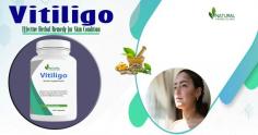 In your journey to manage vitiligo, embrace a holistic approach, and explore the potential benefits of a balanced Vitiligo Diet and Remedies, aloe vera, herbal treatments, and natural remedies.
