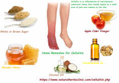 5 Natural Herbal Remedies for Cellulitis
Manuka Honey is one of the useful Natural Herbal Remedies for Cellulitis. Unprocessed, raw manuka honey can be great at reduction the unpleasant symptoms that go with a skin condition like Cellulitis.
https://www.naturalherbsclinic.com/blog/natural-remedies-for-cellulitis/
