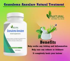 Get help understanding the best Granuloma Annulare Relief Methods. Learn more about natural treatments, medications, and other remedies that may help you find relief.
