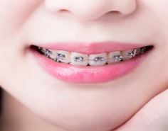 We are the best dental clinic for braces treatments in Vijayawada. Dr Ramya is a profound clinician for Orthodontic treatment and specializes in all types of braces, including Invisalign and ortho treatment.