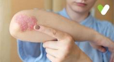 Psoriasis is a skin disease that causes a rash with itchy, scaly patches on body parts. Visit the Livlong website to get more information on psoriasis symptoms, causes & its types.