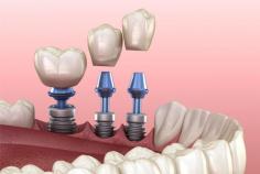 What is Dental Implant?
A dental implant is a small titanium post that is surgically placed into the jawbone to serve as the root of a missing tooth. Once the implant has fused to the jawbone, a replacement tooth called a crown can be attached to the implant. This provides a stable, long-term solution for missing teeth and can improve the appearance and function of the smile.