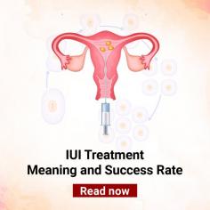 IUI (Intrauterine Insemination): Understand the Importance of IUI Treatment at Indira IVF

IUI (Intrauterine Insemination): Advanced IUI treatment helps in treating infertility problem in couples. Learn about the importance of Intrauterine Insemination in addressing infertility. For more information, visit: https://www.indiraivf.com/infertility-treatment/intrauterine-insemination-iui-treatment