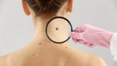 Learn about the effects of Basal Cell Nevus Syndrome on quality of life, including physical and emotional challenges and how to manage them.
