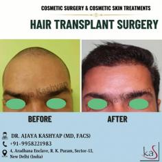 Are you tired of thinning hair or baldness? Do you want a natural-looking solution that will restore your confidence and self-esteem? Look no further than our hair transplant clinic!

Our team of experienced surgeons uses the latest techniques to transplant healthy hair follicles from donor areas to the areas affected by hair loss. The results are completely natural-looking and long-lasting, giving you a full head of hair that you can be proud of.