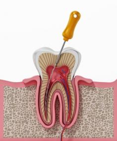 Best Root Canal Treatment in Hadapsar Pune | Root Canal Treatment in Pune Near Me

Platinum Smile dental clinic - The Best Root Canal Treatment in Pune Near Me ✓ root canal in Pune ✓ Affordable Root Canal Cost in Pune, India ✓ Best Tooth Root Canal
