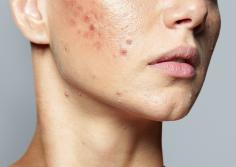 If you are struggling with lichen planus on face, you may be looking for ways to get rid of it quickly and effectively. Some of the best treatments for lichen planus on face, so you can clear your skin and regain your confidence. The exact cause of Lichen Planus on Face is still unknown, but it is believed to be an autoimmune condition. This means that the body’s immune system mistakenly attacks healthy skin cells, leading to inflammation and the characteristic symptoms of lichen planus.