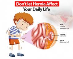 Discover effective hernia treatment options at Mukat Hospital in Chandigarh. Our skilled specialists offer personalized care for hernia repair, ensuring comprehensive treatment and optimal recovery. Contact us for expert care tailored to your needs. 
Visit : Mukat Hospital
Address : S.C.O 47-49, Dakshin Marg, Sector 34A, Chandigarh 160022
https://maps.app.goo.gl/un65vakQZPDc8pfc7
Phone : +91 9023-88-4444, +91-9545-12-4000, 0172-4344444
Weblink : https://www.mukathospital.com/understanding-hernia-what-it-is-symptoms-types-causes-treatment/