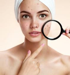 MedSpa California offers the best laser acne treatment in Danville. Board-certified dermatologists are dedicated to treating teen and adult acne removal in San Ramon.
