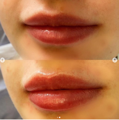 In our experience, the vast majority of people are looking for a gentle re-volumisation of lips that may have thinned with the passage of time.

Know more: https://www.regentstreetclinic.co.uk/lip-fillers/